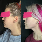 RF Body & Face Sculpting Course